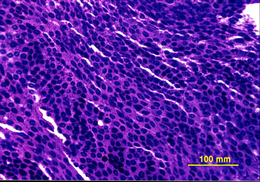 Microscopio ad alta potenza che mostra cellule tumorali renali a cellule chiare metastatiche nel tessuto mammario, illuminazione controllata, obiettivo macro 100mm, alta definizione.