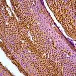 Immagine al microscopio ad alta definizione di cellule di carcinoma squamoso del cavo orale con colorazione immunoistochimica per PD-L1, evidenziando la membrana cellulare marrone delle cellule positive, lente macro 105mm, illuminazione controllata e precisa.