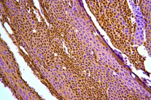 Immagine al microscopio ad alta definizione di cellule di carcinoma squamoso del cavo orale con colorazione immunoistochimica per PD-L1, evidenziando la membrana cellulare marrone delle cellule positive, lente macro 105mm, illuminazione controllata e precisa.