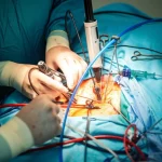 Primo piano fotorealistico di un chirurgo che esegue una chirurgia endoscopica biportale unilaterale (UBE) sulla colonna vertebrale, con focus sugli strumenti endoscopici e il campo operatorio irrigato con soluzione salina, obiettivo prime 35mm, profondità di campo ridotta, illuminazione chirurgica precisa.