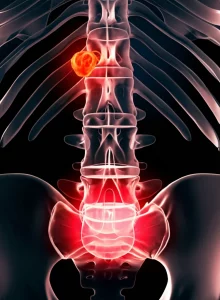 Visualizzazione 3D fotorealistica della colonna vertebrale umana con un focus sullo spazio epidurale, evidenziando un'area di infiammazione o ascesso simile a quella descritta nei casi clinici post-ureteroscopia. Illuminazione drammatica da studio, Macro lens 100mm, alta definizione, dettaglio preciso sull'area patologica.