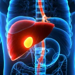 Visualizzazione medica 3D generata da TAC Dual-Energy che mostra il fegato e la milza ingranditi di un paziente con cirrosi, evidenziando con colori contrastanti le varici esofagee lungo l'esofago e le aree di perfusione alterata nel fegato, illuminazione drammatica per enfatizzare i dettagli patologici, obiettivo virtuale 50mm, alta risoluzione.