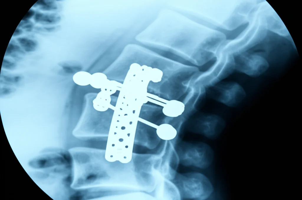Immagine fotorealistica di un chirurgo che esamina una radiografia C-arm laterale della colonna lombare durante un intervento, mostrando l'impianto Vertiwedge posizionato in una vertebra L4 dopo un'osteotomia. Illuminazione da sala operatoria, dettagli nitidi sulla radiografia e sull'impianto. Obiettivo prime 35mm, profondità di campo che sfoca leggermente lo sfondo.