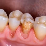 Primo piano macro di una gengiva umana che mostra chiari segni di recessione gengivale, con la superficie della radice del dente visibilmente esposta. Obiettivo macro 100mm, alta definizione dei dettagli tissutali, illuminazione clinica controllata e precisa per evidenziare la texture e il colore della gengiva e del dente.