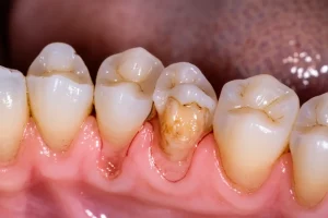 Primo piano macro di una gengiva umana che mostra chiari segni di recessione gengivale, con la superficie della radice del dente visibilmente esposta. Obiettivo macro 100mm, alta definizione dei dettagli tissutali, illuminazione clinica controllata e precisa per evidenziare la texture e il colore della gengiva e del dente.