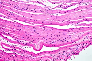 Immagine macro fotorealistica di tessuto miocardico umano che mostra segni evidenti di ipertrofia, con fibre muscolari visibilmente ingrossate e aree interstiziali indicative di fibrosi. Lente macro 90mm, illuminazione laterale controllata per enfatizzare la texture tridimensionale del tessuto, alta definizione, focus nitido sulle alterazioni strutturali.