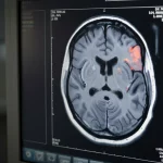 Scansione MRI 3D del cervello umano che mostra segni di atrofia, in particolare nell'ippocampo e nei lobi temporali, visualizzata su uno schermo medico high-tech. Illuminazione drammatica laterale, obiettivo 50mm prime, profondità di campo che sfoca lo sfondo per concentrarsi sulla scansione, toni blu e grigi duotone.