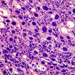 Visualizzazione al microscopio ad alta definizione di cellule di carcinoma renale a cellule chiare (ccRCC) di grado 4, evidenziando la netta differenza morfologica tra la componente a cellule chiare e quella sarcomatoide aggressiva. Lente macro 90mm, illuminazione da laboratorio precisa, focus selettivo sulle strutture cellulari indicative della prognosi.