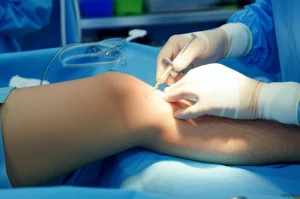 Fotografia in stile documentaristico, obiettivo 50mm, che mostra un chirurgo ortopedico mentre esegue un'aspirazione di liquido sinoviale da un ginocchio protesizzato in sala operatoria, luce controllata, focus sui dettagli della procedura e sulla sterilità dell'ambiente.