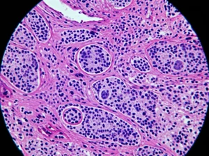 Immagine al microscopio ad alta risoluzione di cellule di adenocarcinoma endocervicale con marcatori immunoistochimici visibili (es. PD-L1 o CD8). Contrasto tra cellule tumorali (più grandi, atipiche) e infiltrato immunitario (cellule più piccole, scure). Lente macro 105mm, illuminazione da laboratorio controllata, focus nitido sulle strutture cellulari e sulla loro interazione.