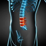 Immagine 3D ad alta definizione di una colonna vertebrale umana con focus sulla giunzione toraco-lombare, evidenziando le vertebre L1-L3 con colori differenti per indicare diverse densità ossee (Unità Hounsfield), illuminazione da studio, sfondo neutro digitale.