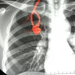 Visualizzazione medica drammatica di un emotorace destro con evidenza di una vena varicosa intratoracica rotta vicino al mediastino, collegata alla sindrome di Budd-Chiari, fotografia medica, obiettivo prime 35mm, profondità di campo, illuminazione controllata per evidenziare il sangue e la vena.