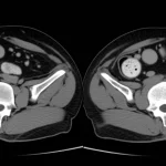 Immagine medica fotorealistica che mostra un confronto affiancato di scansioni TC e RM del bacino, evidenziando i linfonodi regionali in un paziente con cancro rettale. Illuminazione da studio medico, focus nitido sui linfonodi valutati con il sistema Node-RADS, leggera profondità di campo.