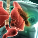 Illustrazione medica fotorealistica del timo umano posizionato nel torace, con un focus sulla sua struttura cellulare e una rappresentazione astratta di cellule immunitarie che interagiscono con la parete intestinale danneggiata sullo sfondo. Obiettivo prime 50mm, profondità di campo, illuminazione drammatica ma chiara, a simboleggiare la connessione tra timoma, autoimmunità ed enteropatia.
