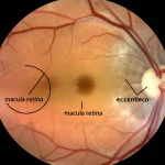 Illustrazione fotorealistica della sezione trasversale di un occhio umano, con un ingrandimento sulla macula retinica. Si vede un foro maculare centrale chiuso chirurgicamente, ma lateralmente è visibile un secondo foro maculare eccentrico più piccolo, circondato da un'area di retina assottigliata e atrofica. Dettagli anatomici precisi, illuminazione che evidenzia la patologia, stile medico-scientifico.