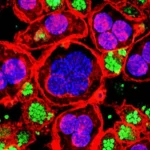 Visualizzazione fotorealistica al microscopio del microambiente tumorale del carcinoma ovarico sieroso di alto grado (HGSC), obiettivo macro 105mm, alta definizione, illuminazione controllata, che mostra cellule tumorali epiteliali interagenti con diverse cellule immunitarie (linfociti T, macrofagi) in un contesto complesso e dinamico.
