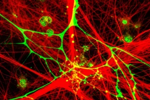 Immagine macrofotografica ad alta risoluzione, lente macro 90mm, illuminazione controllata da studio, che mostra un'area di tessuto epatico danneggiato con evidenti detriti cellulari necrotici, evidenziando filamenti di DNA (colorati fluorescentemente in verde) e actina (colorata fluorescentemente in rosso) intrappolati in una matrice proteica simile a fibrina, con alcune cellule immunitarie (visibili come piccoli punti luminosi) che iniziano ad avvicinarsi all'area danneggiata.