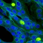 Immagine fotorealistica al microscopio elettronico di cellule di adenocarcinoma polmonare (LUAD) con evidenziazione molecolare fluorescente del gene STC2 all'interno dei nuclei cellulari, resa con dettagli elevati e illuminazione drammatica blu e verde duotone, obiettivo macro 90mm, profondità di campo.