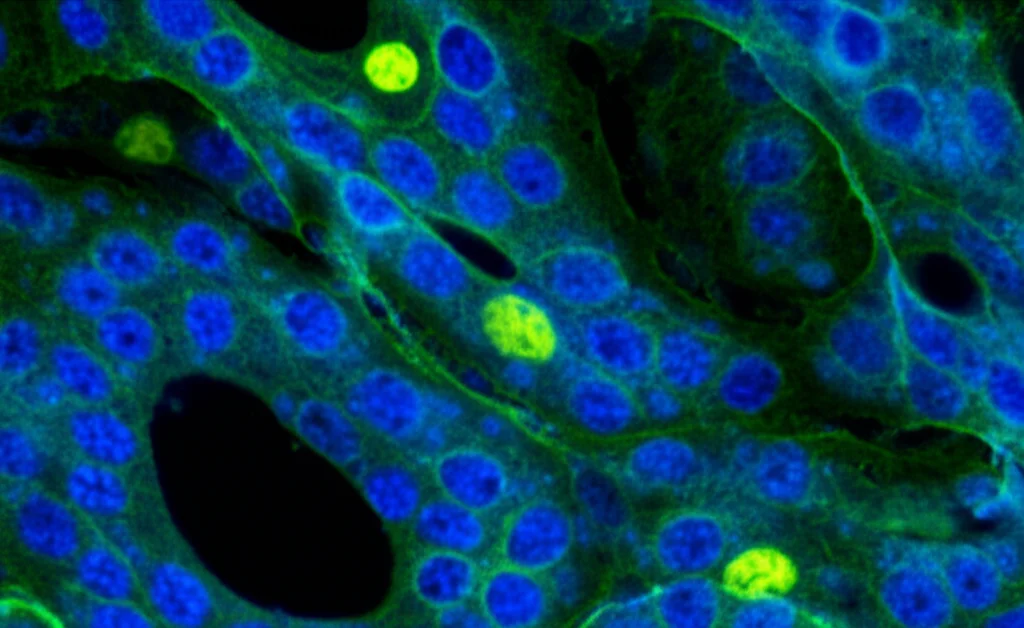 Immagine fotorealistica al microscopio elettronico di cellule di adenocarcinoma polmonare (LUAD) con evidenziazione molecolare fluorescente del gene STC2 all'interno dei nuclei cellulari, resa con dettagli elevati e illuminazione drammatica blu e verde duotone, obiettivo macro 90mm, profondità di campo.