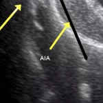 Immagine ecografica ad alta risoluzione dell'avambraccio distale che mostra chiaramente il nervo interosseo anteriore (NIA) e l'arteria interossea anteriore (AIA) che corrono sulla membrana interossea, profondamente al muscolo pronatore quadrato (PQ). Le ossa radio e ulna sono visibili ai lati. Lente macro 100mm, alta definizione, illuminazione controllata, focus preciso sulle strutture neurovascolari.