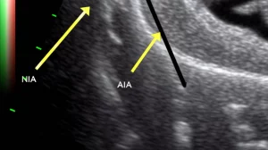 Immagine ecografica ad alta risoluzione dell'avambraccio distale che mostra chiaramente il nervo interosseo anteriore (NIA) e l'arteria interossea anteriore (AIA) che corrono sulla membrana interossea, profondamente al muscolo pronatore quadrato (PQ). Le ossa radio e ulna sono visibili ai lati. Lente macro 100mm, alta definizione, illuminazione controllata, focus preciso sulle strutture neurovascolari.