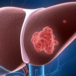 Visualizzazione 3D fotorealistica del fegato umano con evidenziate piccole metastasi tumorali precoci provenienti dal colon-retto, obiettivo macro 100mm, illuminazione drammatica laterale per creare ombre e profondità, focalizzazione precisa sulle lesioni metastatiche, alto dettaglio anatomico delle strutture epatiche e vascolari.