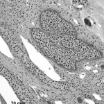 Visualizzazione microscopica ad alta risoluzione di cellule di carcinoma a piccole cellule della vescica, obiettivo macro 70mm, illuminazione da laboratorio controllata. L'immagine mostra la morfologia cellulare tipica e suggerisce l'analisi immunoistochimica utilizzata nello studio per identificare fattori di trascrizione come NEUROD1 e POU2F3.