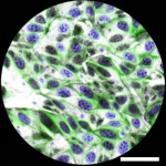Immagine al microscopio ad alta risoluzione di tessuto vescicale murino infiammato. Si notano cellule PDGFRα+ (evidenziate con fluorescenza verde stilizzata) proliferate nella regione suburoteliale, circondate da un'abbondante matrice extracellulare densa (fibre di collagene simili a cicatrice). Lente macro 90mm, illuminazione da laboratorio controllata, focus preciso sulle cellule trasformate e sulla fibrosi tissutale.