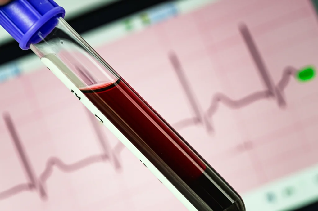 Primo piano macro di una provetta di sangue con sfondo sfocato di un monitor ECG che mostra un ritmo cardiaco alterato, illuminazione controllata da laboratorio focalizzata sulla provetta, lente macro 90mm, alta definizione dei componenti sanguigni visibili.