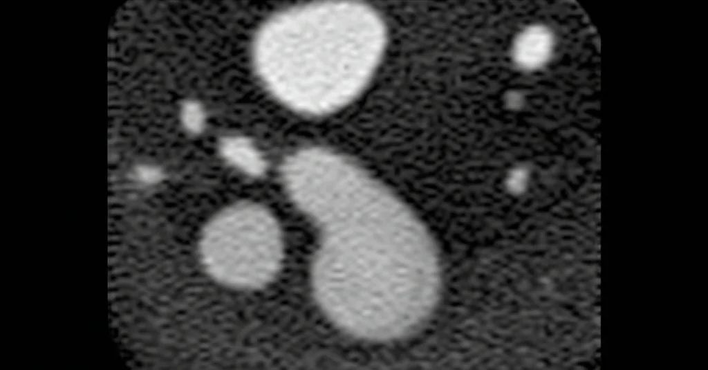 Fotografia macro ad alta definizione di linfonodi pelvici visualizzati su una scansione MRI, lente macro 100mm, illuminazione controllata, che evidenzia la difficoltà nel distinguere i linfonodi sani da quelli metastatici nel cancro rettale precoce.