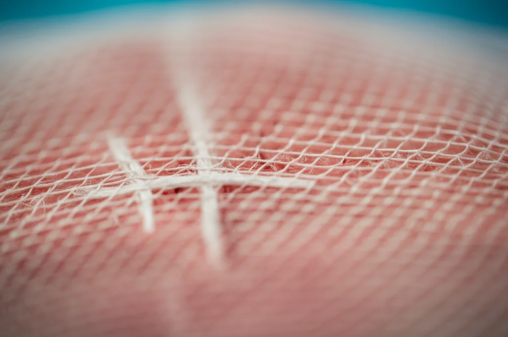 Fotografia macro di una rete chirurgica sintetica (mesh) posizionata delicatamente su tessuto muscolare durante un intervento di riparazione di ernia incisionale. Obiettivo macro 100mm, alta definizione, illuminazione chirurgica controllata, messa a fuoco precisa sulla trama della rete e sul tessuto circostante.