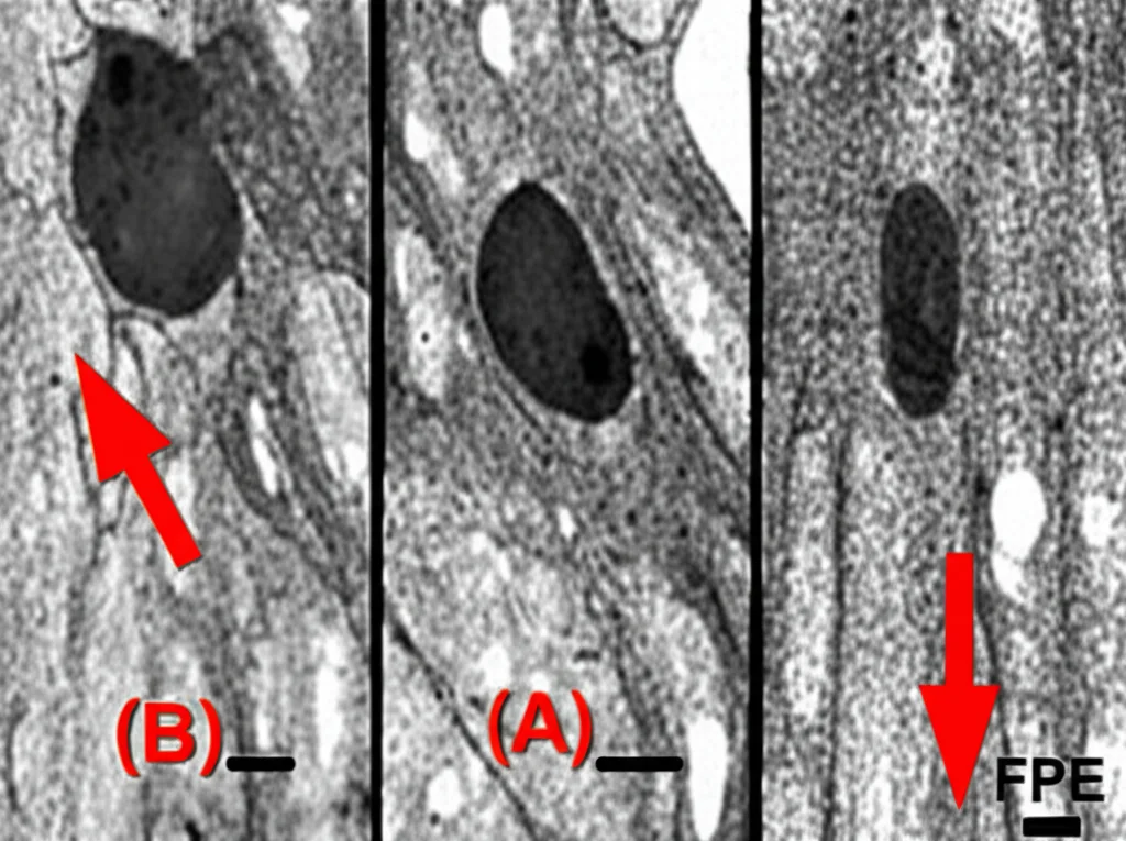 Immagine al microscopio elettronico a trasmissione (TEM) di podociti glomerulari, obiettivo macro 100mm, alta definizione, illuminazione controllata, che mostra processi podocitari normali (A) e aree con fusione estesa dei processi - FPE (B), frecce rosse indicano la fusione.