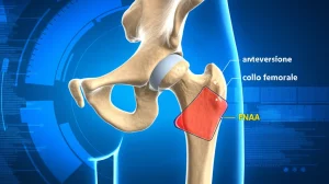 Ricostruzione 3D fotorealistica di un femore umano su uno sfondo digitale blu high-tech, con l'angolo di anteversione del collo femorale (FNAA) evidenziato da linee e misurazioni digitali sovrapposte, illuminazione da studio che enfatizza la forma ossea, dettagli nitidi.