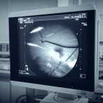 Immagine fotorealistica di una sala di radiologia interventistica. Schermo fluoroscopico in primo piano mostra la pinza da biopsia endovascolare all'interno della vena cava inferiore. Obiettivo prime 35mm, stile film noir, duotone blu e grigio, profondità di campo.