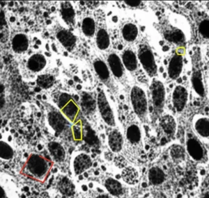 Visualizzazione microscopica fotorealistica di cellule di cancro pancreatico (PDAC) che mostrano caratteristiche mesenchimali aggressive. In evidenza l'interazione tra le proteine TRPM7 e PAK1, suggerita da segnali fluorescenti o collegamenti molecolari. Alta definizione, illuminazione da laboratorio controllata, lente macro 85mm.