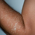 Radiografia dettagliata che mostra numerose calcificazioni a forma di chicco di riso diffuse nei tessuti molli di un arto, alta definizione, illuminazione drammatica per evidenziare le calcificazioni, obiettivo macro 100mm.