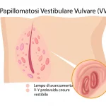 Illustrazione medica stilizzata che mostra l'anatomia vulvare con evidenziate le piccole papule rosa della Papillomatosi Vestibolare Vulvare (VVP) nel vestibolo, accanto a un diagramma che illustra la tecnica del lembo di avanzamento V-Y prelevato dalla coscia per la ricostruzione vulvare, sfondo bianco pulito, alta definizione.