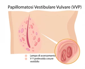 Illustrazione medica stilizzata che mostra l'anatomia vulvare con evidenziate le piccole papule rosa della Papillomatosi Vestibolare Vulvare (VVP) nel vestibolo, accanto a un diagramma che illustra la tecnica del lembo di avanzamento V-Y prelevato dalla coscia per la ricostruzione vulvare, sfondo bianco pulito, alta definizione.