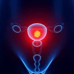 IMMAGINE CONCETUALE CHE RAPRESENTA UN RADIOFARMACO FAPI CHE Illumina Selettivamente cellule tumorali nell'area pelvica femminile, Simbolegiando la diagnosi mirata nei tumori ginecologici. Immagine fotorealistica concettuale, lente primaria, 35 mm, profondità di campo. Una rappresentazione brillante e astratta di una molecola FAPI mira e illuminante le cellule cancerose all'interno di una rappresentazione stilizzata e più scura della regione pelvica femminile. Illuminazione morbida e focalizzata sull'area target.