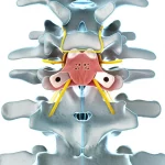 Illustrazione medica dettagliata che mostra la tecnica di laminectomia a isola fluttuante sulla colonna vertebrale toracica, evidenziando la separazione dell'osso dal midollo spinale, alta definizione, stile fotorealistico, luce chirurgica focalizzata.