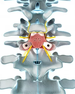 Illustrazione medica dettagliata che mostra la tecnica di laminectomia a isola fluttuante sulla colonna vertebrale toracica, evidenziando la separazione dell'osso dal midollo spinale, alta definizione, stile fotorealistico, luce chirurgica focalizzata.