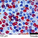 Immagine concettuale fotorealistica che illustra la crescita e la migrazione di cellule tumorali tiroidee, con enfasi sulle interazioni molecolari. Obiettivo macro 100mm, illuminazione controllata, alta definizione.