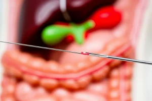 Immagine fotorealistica macro, obiettivo 100mm, alta definizione, illuminazione medica controllata. Mostra la punta di un ago da biopsia percutanea (core needle) posizionata con precisione accanto a un modello simulato di tessuto addominale profondo, con il fegato stilizzato visibile sullo sfondo sfocato, suggerendo l'approccio trans-epatico.