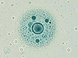 Immagine macro ad alta definizione di un ovocita umano maturo (stadio MII con corpo polare visibile) in una piastra di coltura, circondato da poche cellule del cumulo residue dopo denudazione, illuminazione da laboratorio precisa, lente macro 90mm, focus sui dettagli cellulari, simbolo della riuscita maturazione in vitro e della ricerca sulla fertilità.