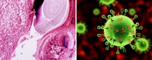 Immagine fotorealistica di una sezione ossea vista al microscopio con dettagli della microarchitettura trabecolare e corticale, accanto a una rappresentazione stilizzata del virus HIV. Utilizzare un obiettivo macro 100mm, illuminazione controllata, alta definizione.