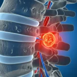 Visualizzazione artistica e fotorealistica di una sezione trasversale di una colonna vertebrale umana con un disco intervertebrale che mostra segni di degenerazione (rosso infiammato) accanto a uno sano (blu calmo), illuminazione laterale drammatica, profondità di campo, dettagli anatomici precisi, obiettivo 35mm.