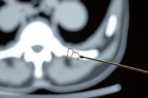 Immagine macro ad alta definizione di un dispositivo medico a forma di ago con un piccolo ancoraggio metallico sulla punta, illuminazione controllata da studio che evidenzia i dettagli precisi, su uno sfondo sfocato di un'immagine TC pelvica. Macro lens, 100mm, high detail, precise focusing.