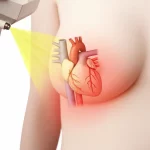 Immagine concettuale che mostra un fascio di radioterapia diretto verso il seno sinistro di una paziente, con una sovrapposizione trasparente del cuore che evidenzia il ventricolo sinistro e l'arteria LADCA come zone potenzialmente ad alta dose, profondità di campo, lente 35mm, colori tenui.