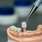 Primo piano di corone dentali in zirconia monolitica traslucida su un modello dentale, con una che viene posizionata da uno strumento odontoiatrico, sfondo sfocato di un laboratorio odontotecnico moderno, illuminazione da studio controllata, obiettivo macro 90mm, alta definizione dei dettagli e della texture della ceramica.