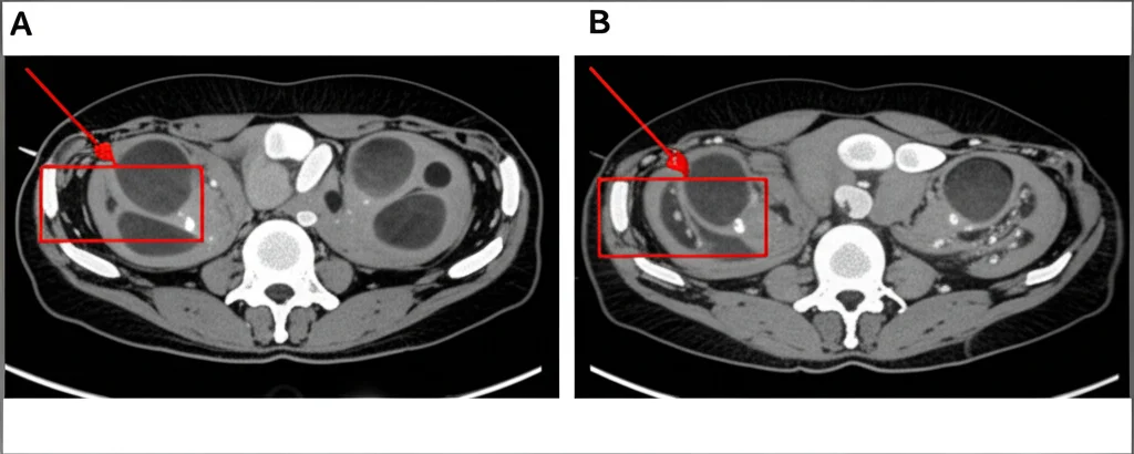 Fotografia medica che mostra un confronto side-by-side di immagini CE-CT, T2WI e T1CE dello stesso linfonodo sospetto in un paziente con cancro rettale. Obiettivo macro 100mm, alta definizione per evidenziare texture, bordi e forma del linfonodo, illuminazione controllata da studio medico.